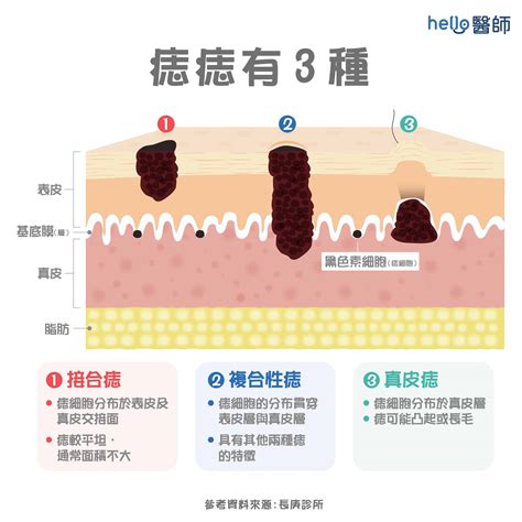 陰囊有痣|陰囊長痣？5大原因揭秘